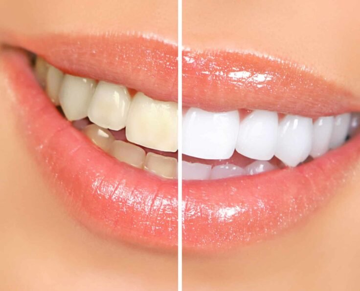teeth-whitening-1
