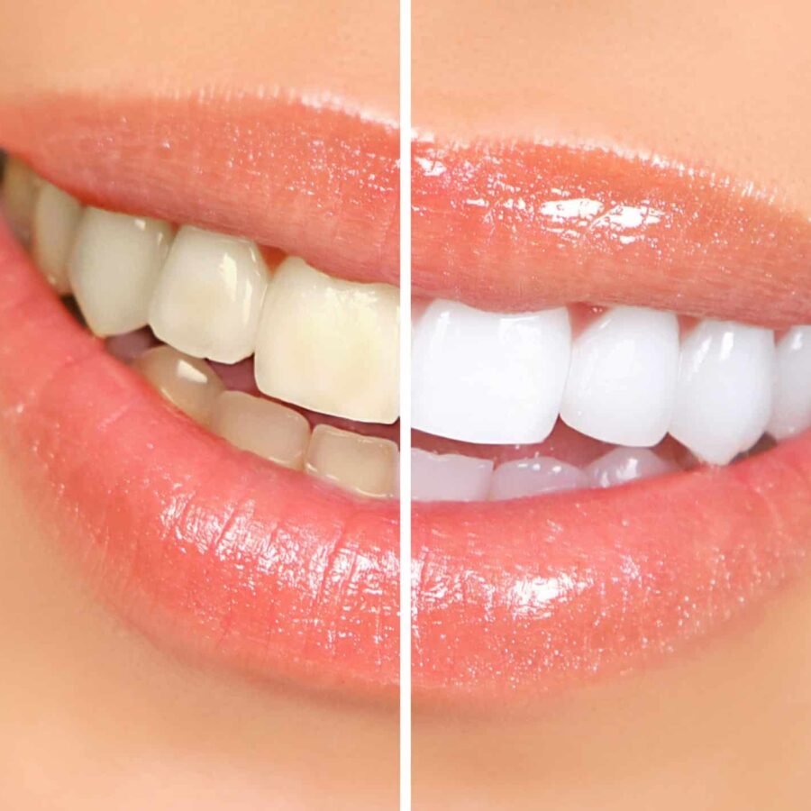 teeth-whitening-1